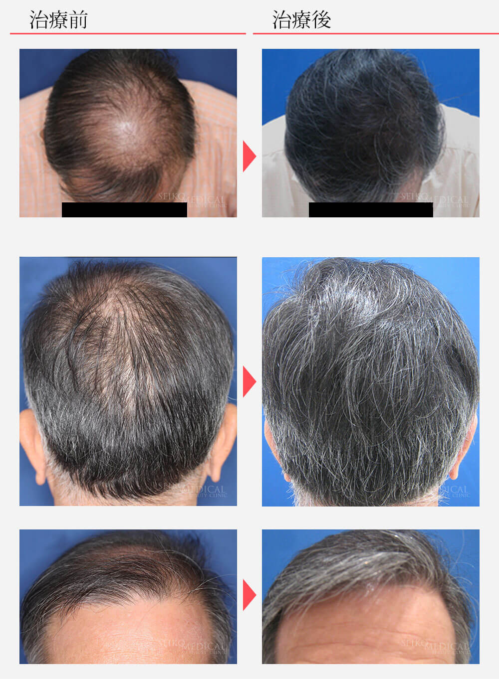 毛髪再生療法 ヘアリバイバル ロゲインフォーム